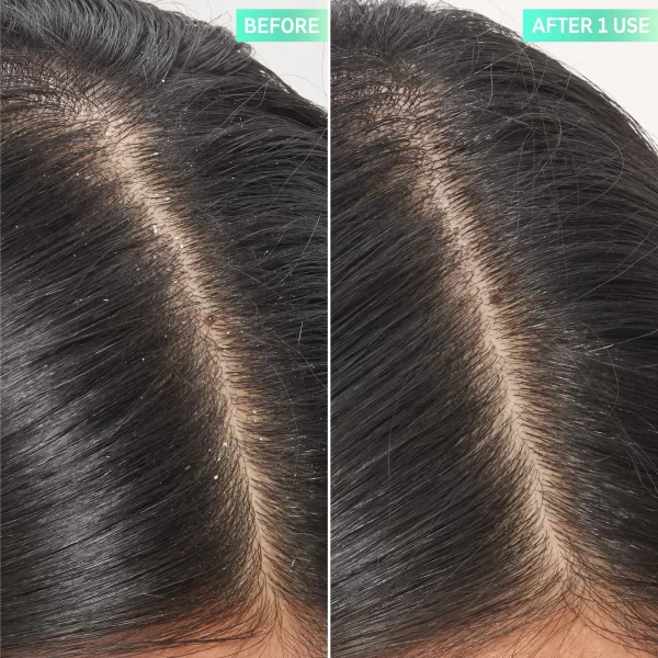 Salicylic Acid Exfoliating Scalp Treatment - Image 2