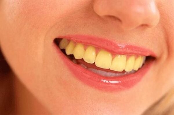 Hismile Teeth Brightening - Image 3